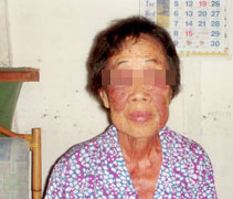 許玉心婆婆以往是靠外出拾荒來維持生活。因不幸患上嚴重皮膚病後，導致她無法工作。【照片提供：北海慈濟社服室】